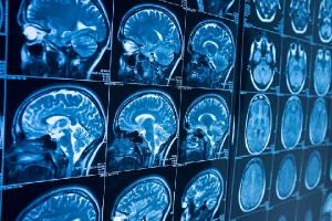 Для чего проводится МРТ обследование головного мозга